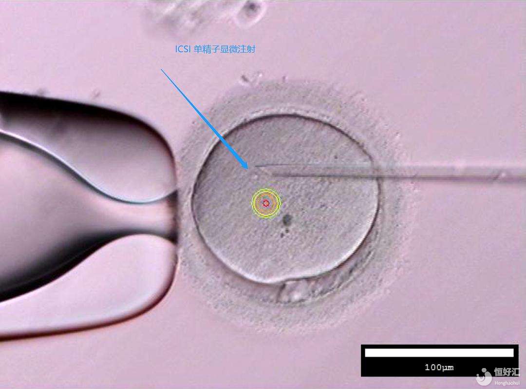 單精子卵泡漿細胞顯微注射技術(shù)是如何進行的呢？