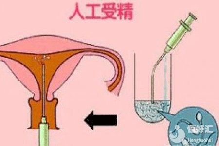 上海人工授精費用講解，這4大因素影響最終價格！