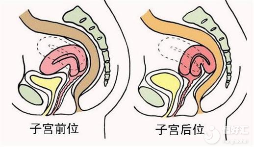 子宮后位或許會(huì)增加不孕幾率，這幾點(diǎn)問(wèn)題請(qǐng)注意