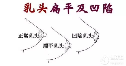 乳頭內(nèi)陷如何喂奶？這些方法希望能幫到你