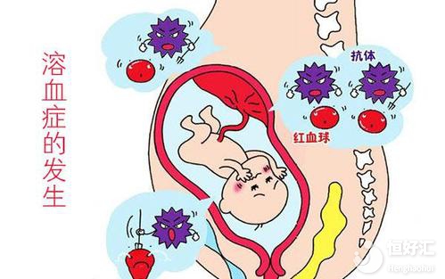 如何診斷新生兒溶血病？醫(yī)生：或許產前檢查就可以