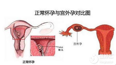 同是宮外孕為什么處理方式不一樣？這一點(diǎn)很關(guān)鍵