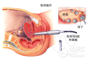 試管嬰兒取卵時(shí)疼嗎?看完這個(gè)你就安心了