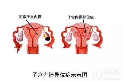 關(guān)于子宮內(nèi)膜異位癥，這里一次性給你講清楚