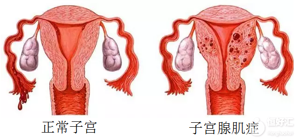 子宮腺肌癥試管嬰兒