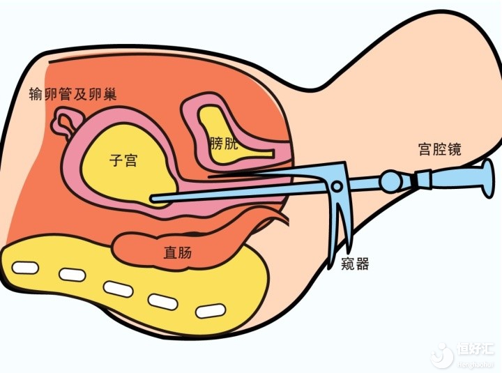 試管嬰兒移植前，為什么醫(yī)生會讓你去做宮腔鏡？