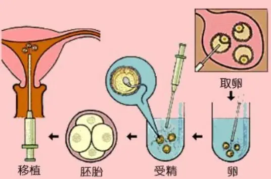 試管嬰兒是怎樣進(jìn)行的，一張實(shí)拍圖告訴你，有些人想生個(gè)娃多不易