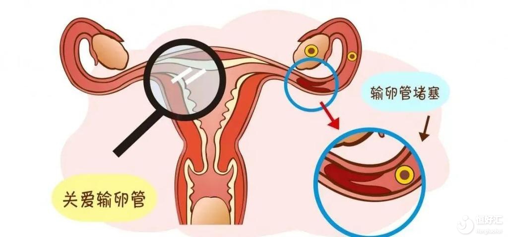 女性輸卵管堵塞的癥狀是什么？