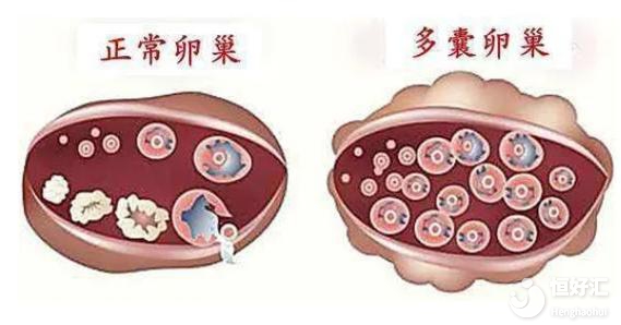 多囊卵巢不運(yùn)動(dòng)不治療，會(huì)導(dǎo)致不孕？